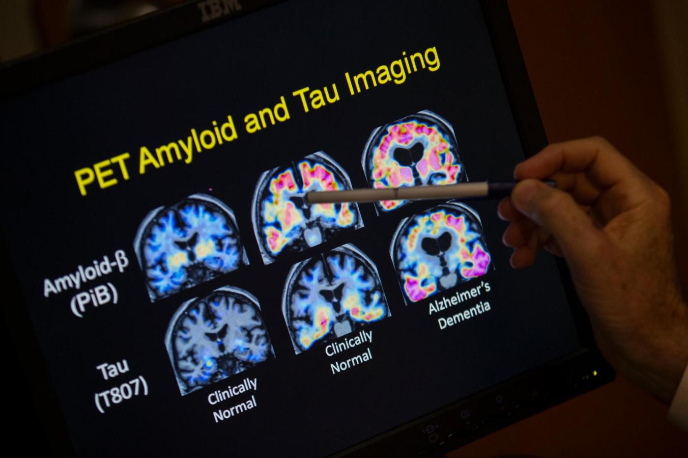 FDA OKs first blood test that can help diagnose Alzheimer’s disease