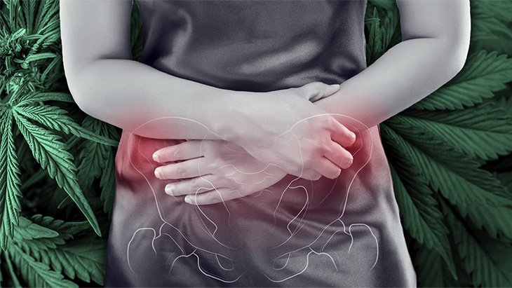 Study: CBD Reduces Chronic Pelvic Pain, Related Symptoms